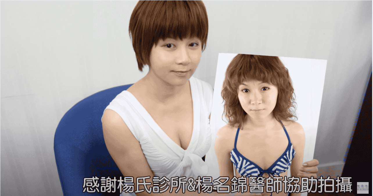 害羞女孩兒Elena心事-自體脂肪豐胸